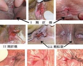 肛裂 肛裂