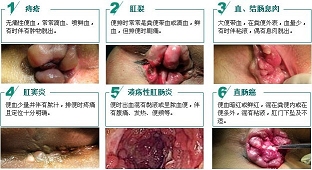 痔疮症状 痔疮症状