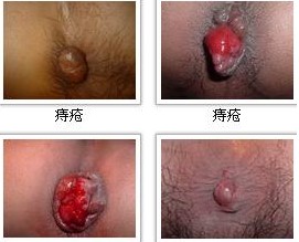 痔疮 痔疮