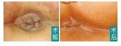 术前术后 术前术后